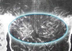 Negative of Shoulder Area of the Shroud of Turin, Highlighting Cross Beam Damage