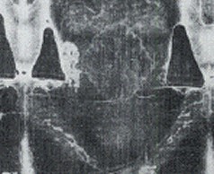 Negative of the Chest Area of the Shroud of Turin
