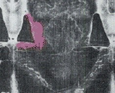 Negative of Chest Area of the Shroud of Turin, Wound Highlighted