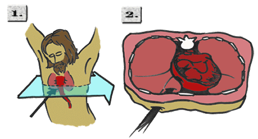 Lance Piecring the Side - Pleural Effusion